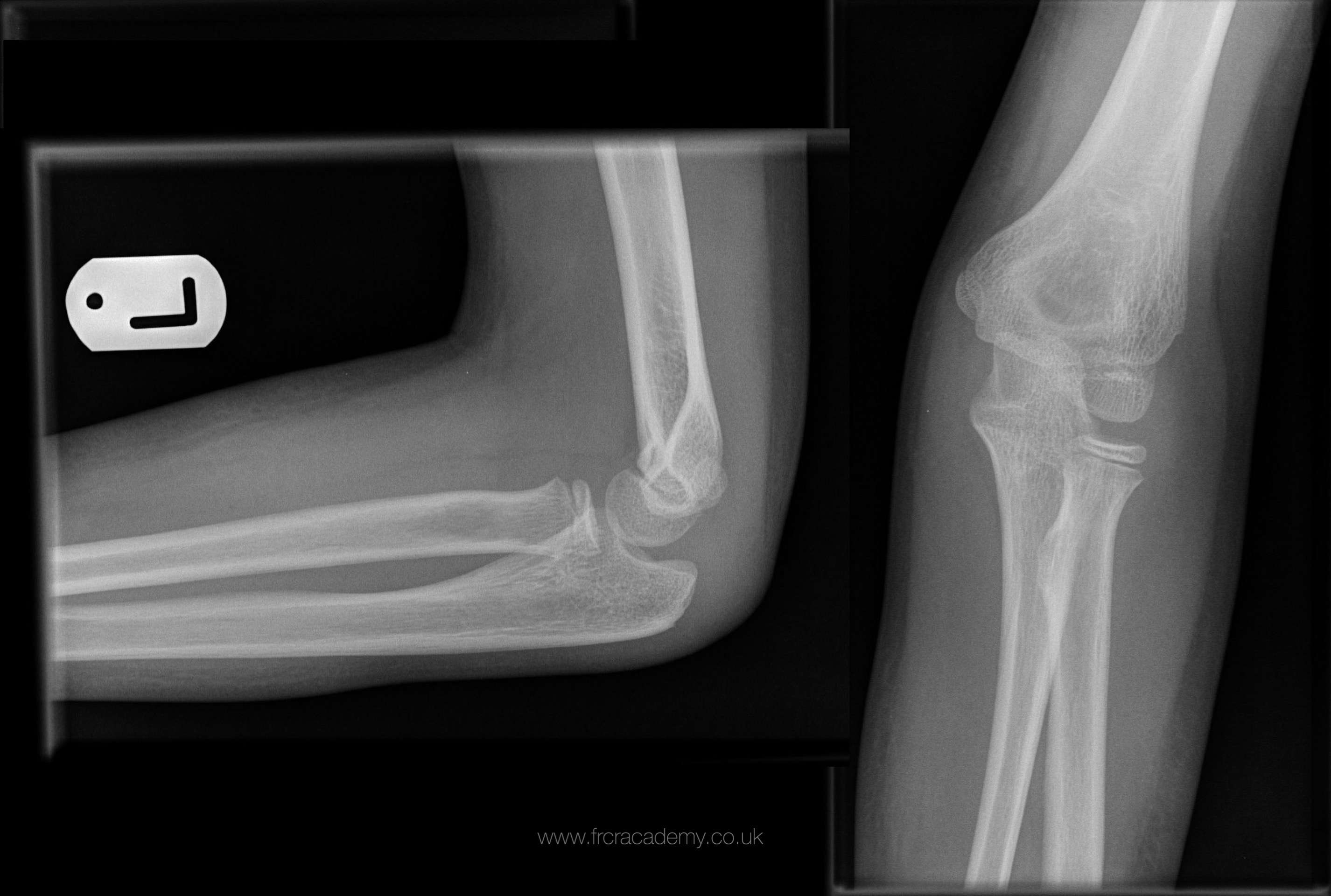 icd 10 code nondisplaced right femoral neck fracture