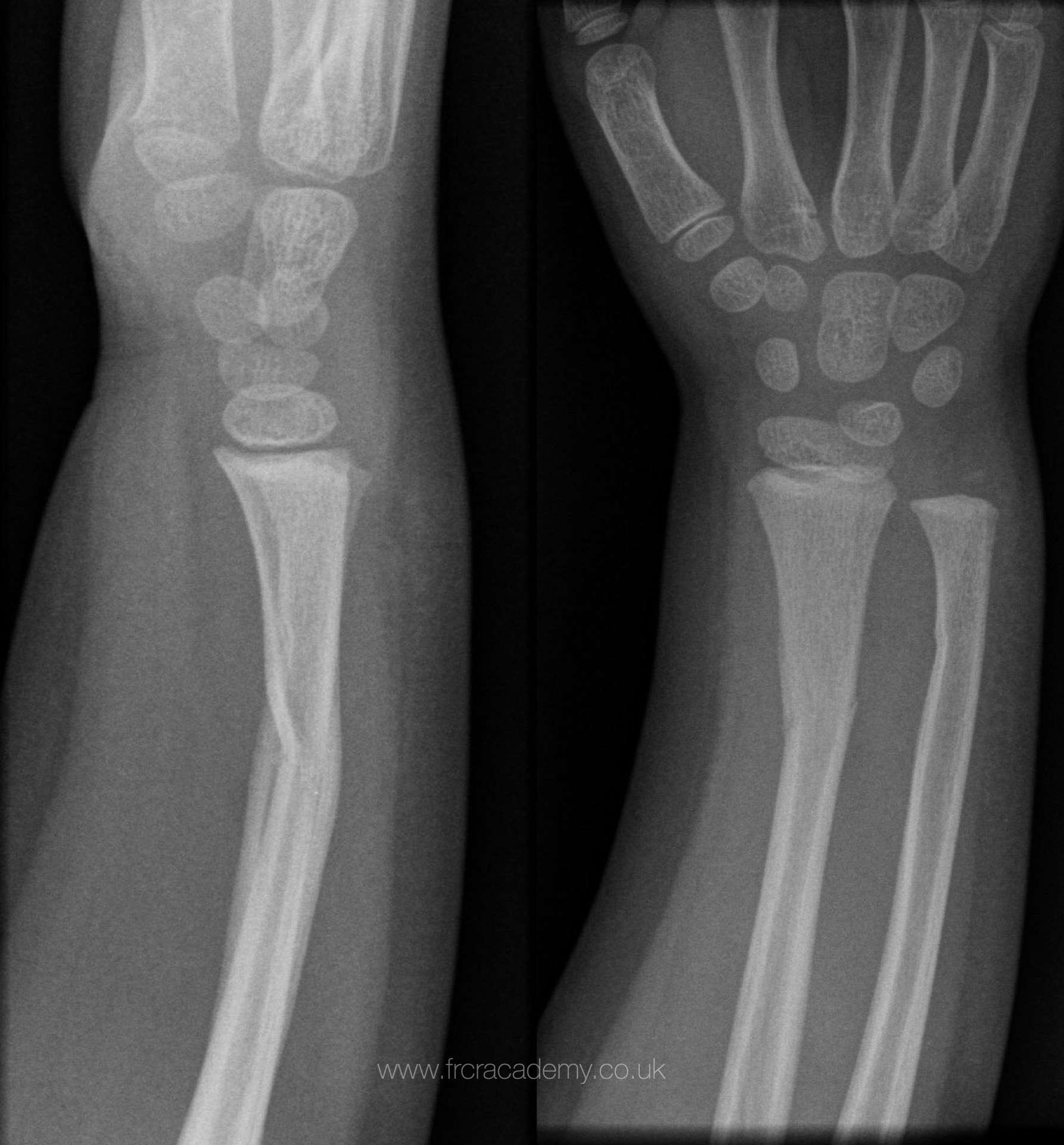 undisplaced radial head fracture icd 10